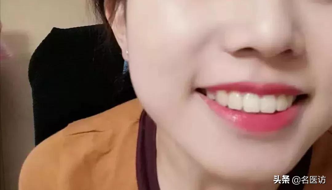 戴牙套2年不戴保持器反弹案例,戴牙套成功案例不戴保持器