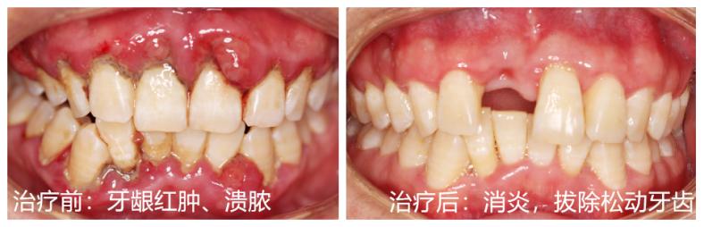 蛀牙与牙周炎哪个更严重,慢性牙周炎口腔健康的头号杀手