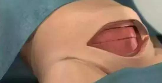 剖腹产要开7层吗,要剖之前孕妈妈该怎么做