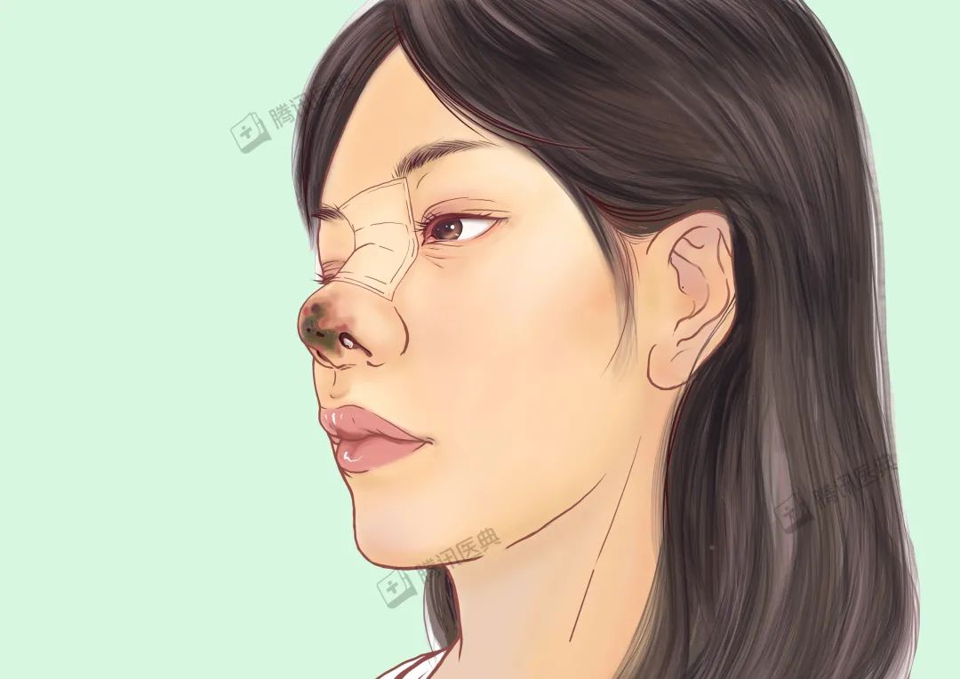 隆鼻的几大风险,隆鼻真的10个做9个后悔吗