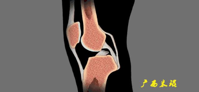 交叉韧带损伤的mr表现,后交叉韧带损伤的诊断实验
