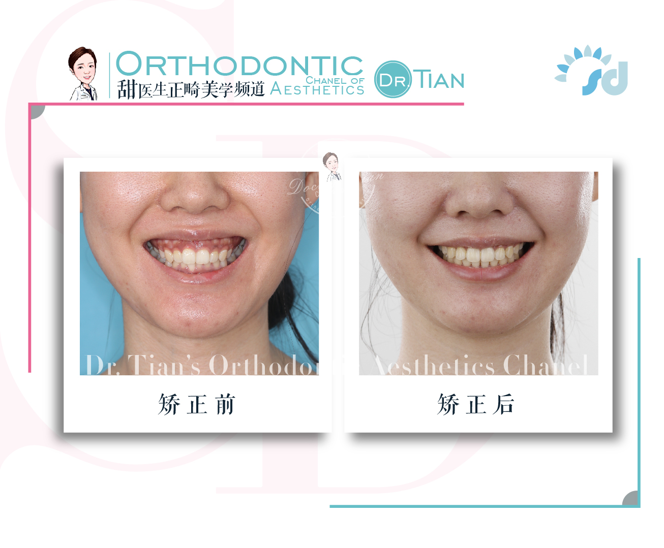 西安哪里有做牙齿矫正,在西安哪里可以做牙齿矫正