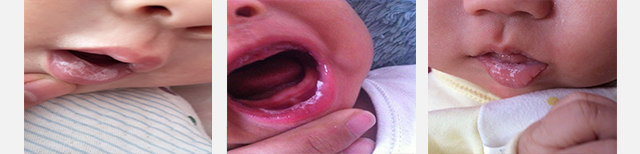 鹅口疮反反复复的怎么办,鹅口疮反反复复怎么才能彻底