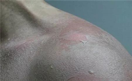 城市温度急剧上升,冬天温度高皮肤干燥瘙痒怎么办