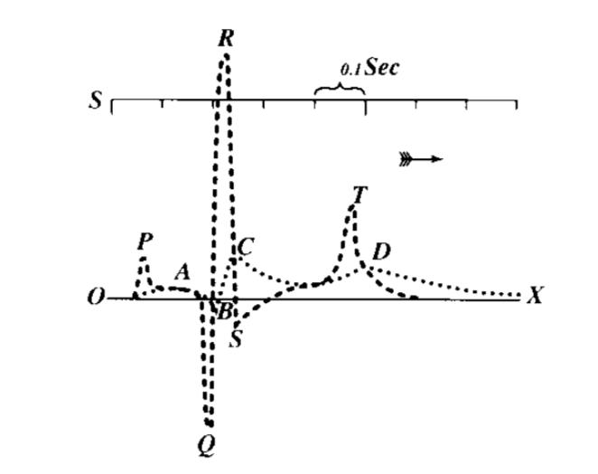 心电图的st向量怎么看,心电图中的sv1代表什么