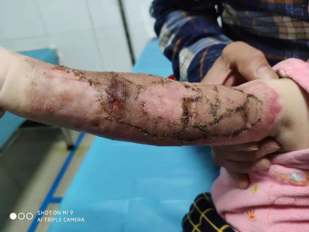 烫伤后及时清创能促进伤口愈合吗,深度烫伤后多久植皮比较好