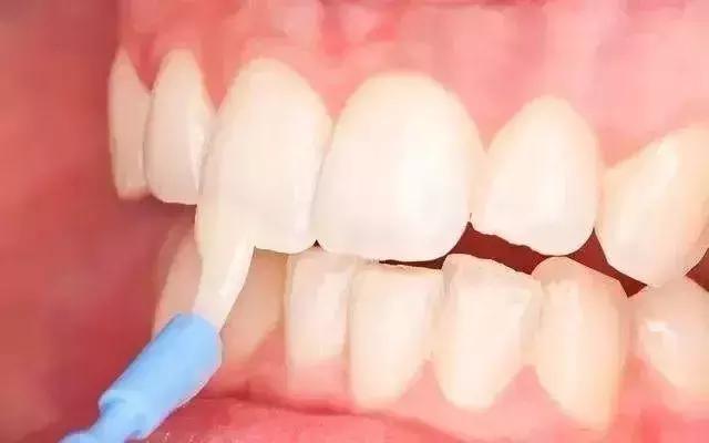 牙齿氟中毒怎么治疗,牙齿发白是氟高了吗