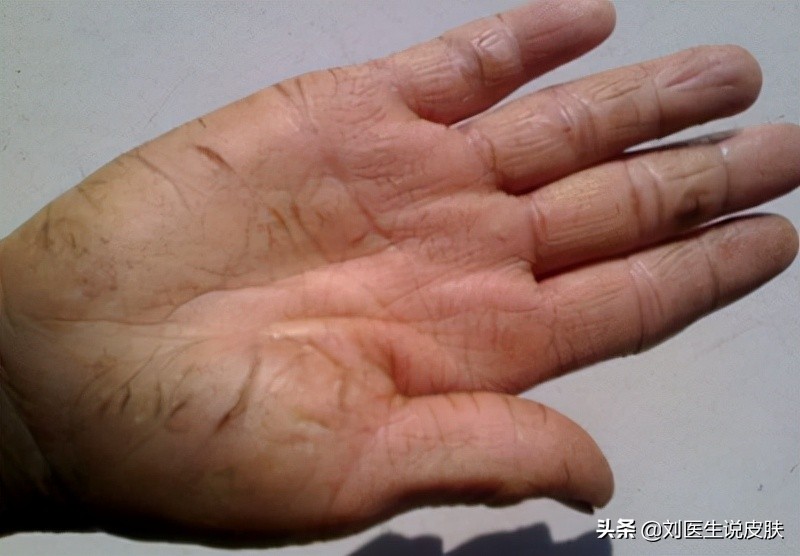 手脚皲裂如何除菌,秋冬季节手脚皲裂怎么办