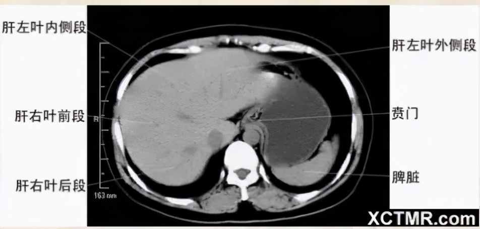 女性盆腔ct断层解剖结构图,女性盆腔脏器ct解剖