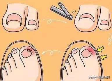 指甲也能剪出错？甲沟炎找上门痛不欲生！这才是剪指甲的正确方式