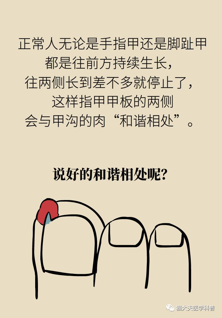 脚趾甲往肉里长怎么治除根,脚趾甲长在肉里面治疗视频