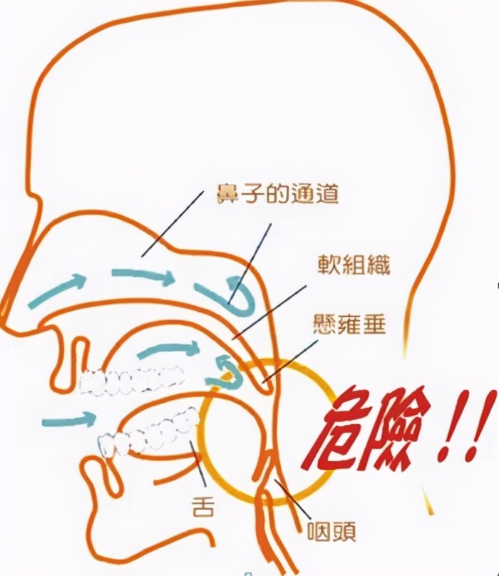 呼吸机止鼾选单水平还是双水平,止鼾呼吸机的正确使用方法