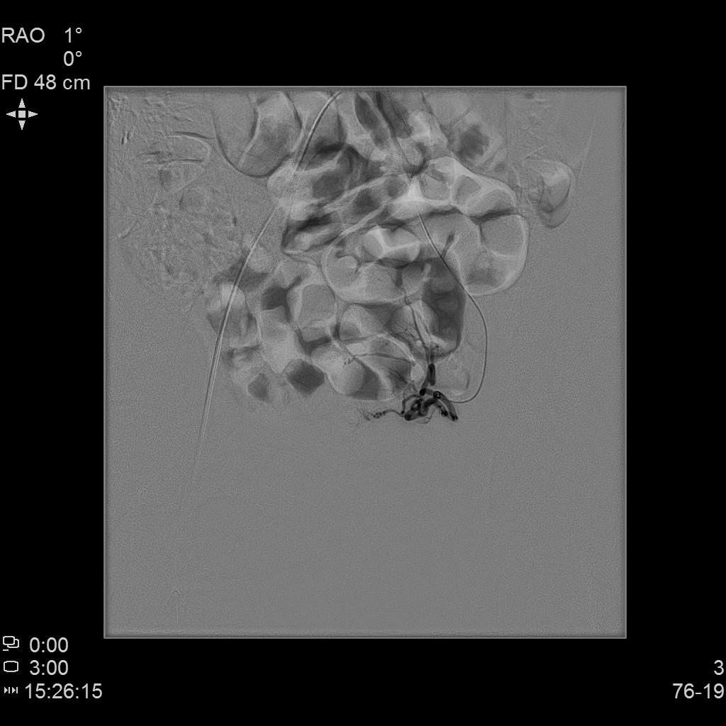 子宫腺肌症介入栓塞全国哪里好,子宫腺肌症介入栓塞治疗报销吗