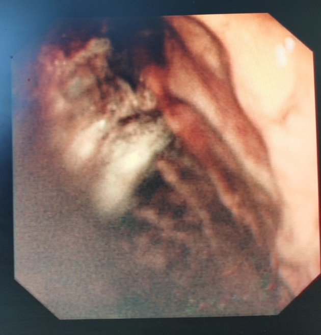 贲门癌吐血抢救,中国最著名的贲门癌治疗专家
