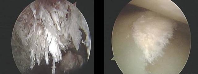 痛风石破溃了怎么能取出痛风石,痛风石破溃后怎么办