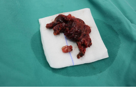 小孩海绵状血管瘤开颅手术,9个小时切除罕见肿瘤