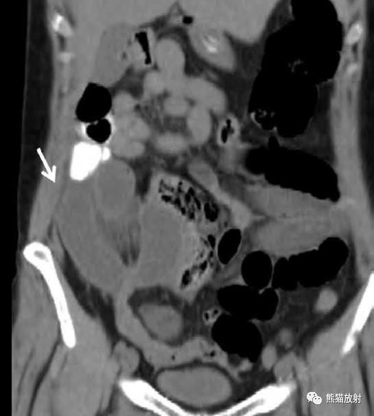 肠系膜解剖图,肠系膜解剖图解