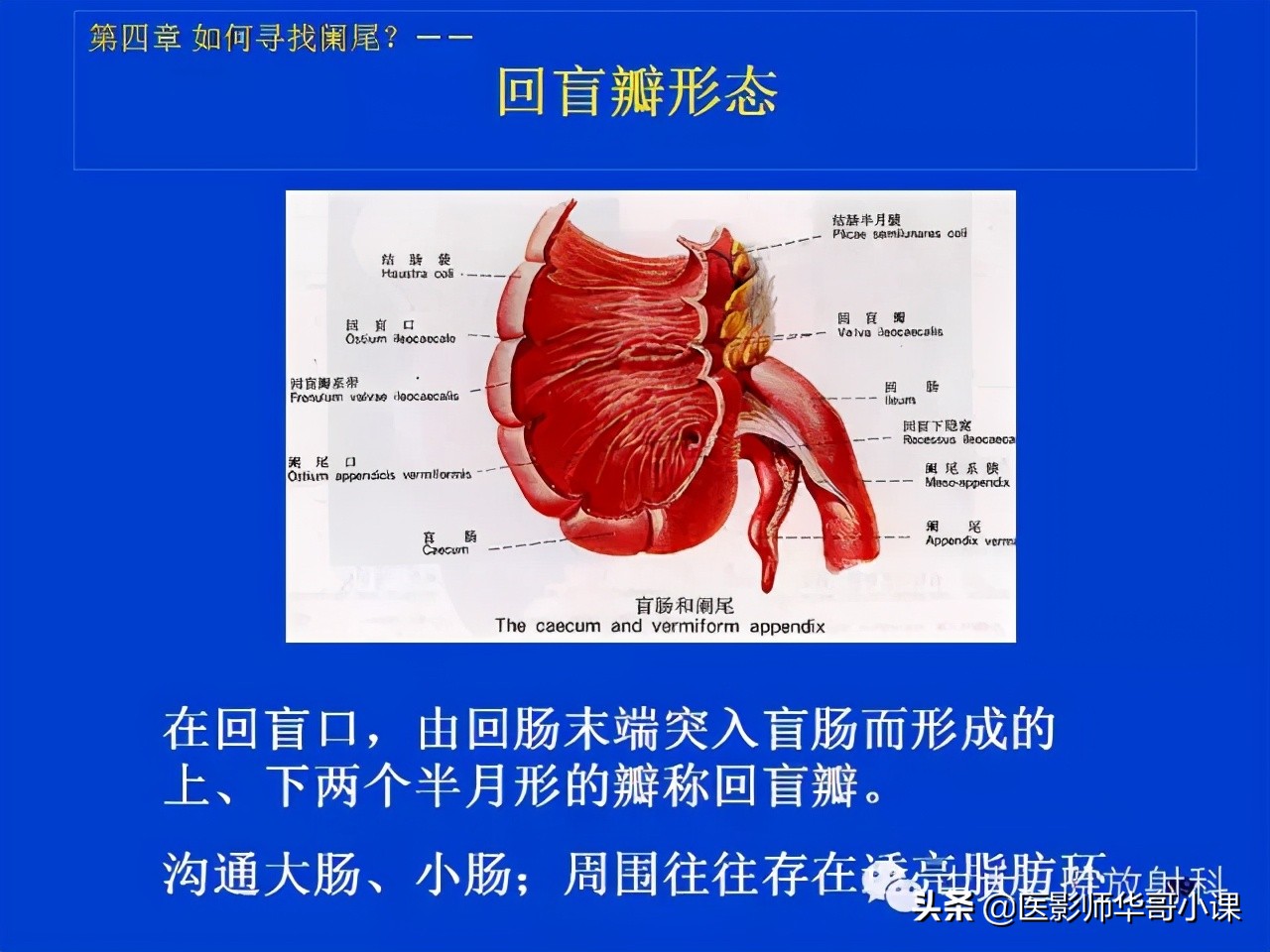 阑尾炎课件,阑尾炎的超声课件
