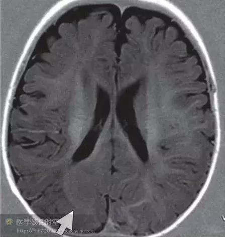 儿童癫痫CT表现,儿童各类癫痫脑电图特征