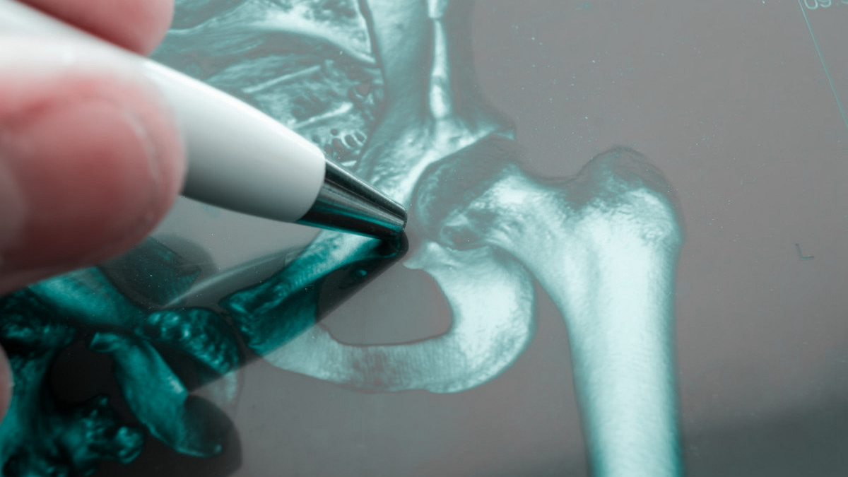 全髋关节置换多久不会感染,关节置换后多久就不会感染了