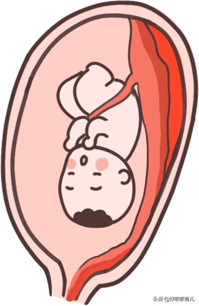 羊水破了胎盘早剥彩超会出现什么,孕妈妈羊水破了肚子疼得要命