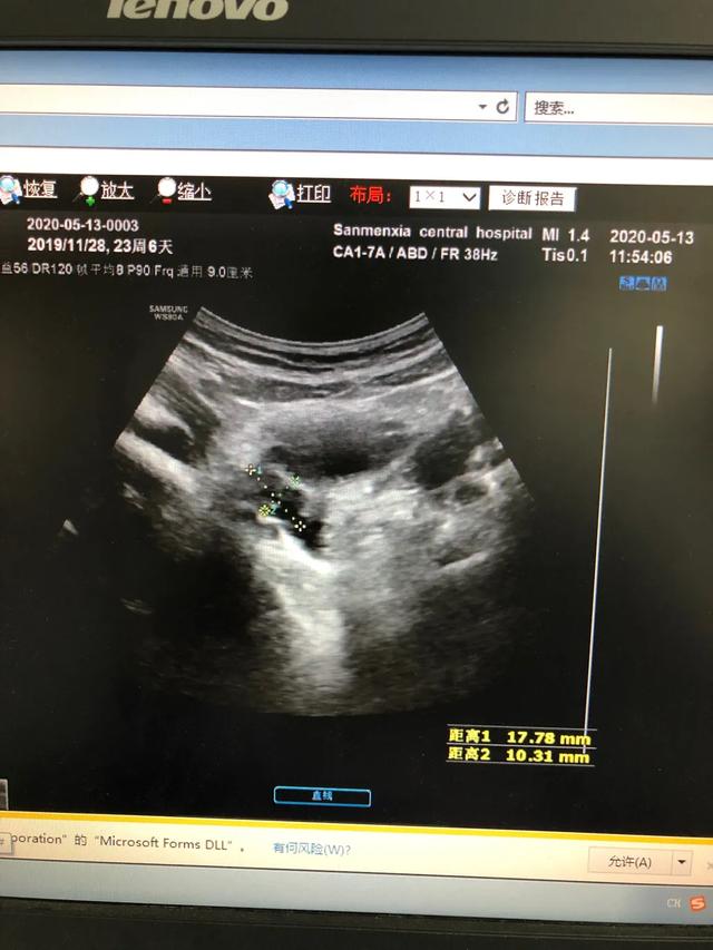 儿童性早熟要做哪些检查？怎么根据这些指标判断真性还是假性？