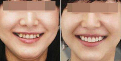 儿童老虎牙矫正,儿童虎斑牙怎么解决