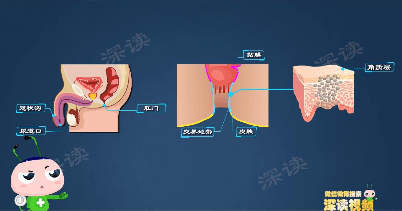 明明没出轨，为啥染上尖锐湿疣？*处私**咋就长出“菜花”了？
