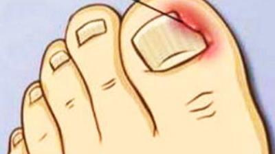 啃指甲拔倒刺危害,手指拔肉刺甲沟炎化脓怎么治