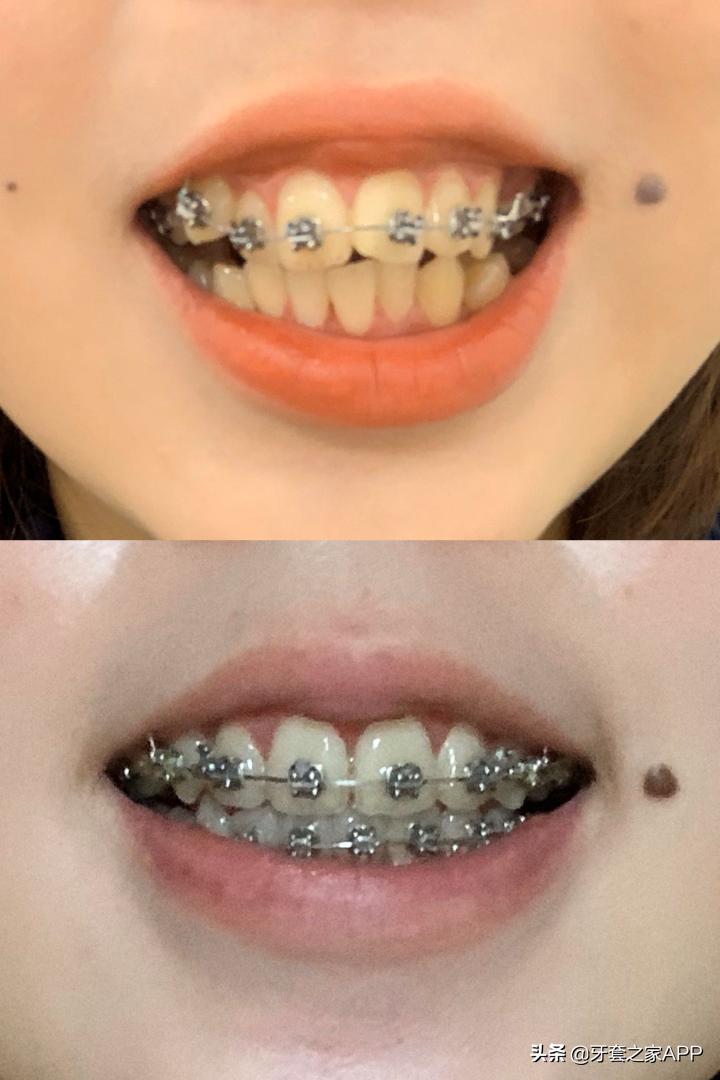 不靠整容怎么改变下巴后缩？看这里