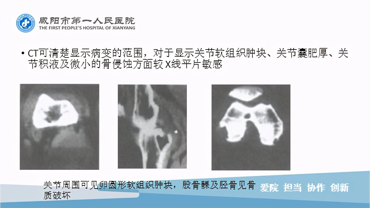 臭氧玻璃酸钠治疗膝关节炎怎么样,膝关节滑膜炎臭氧