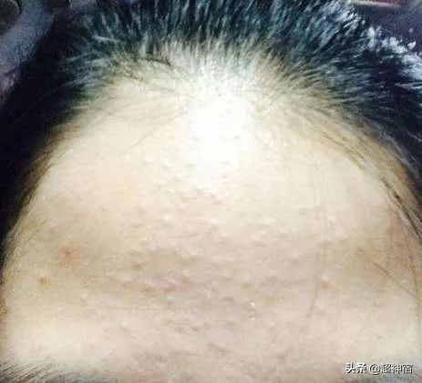 比痘痘更烦人的闭口来了，最有效的去闭口*法大**看过来