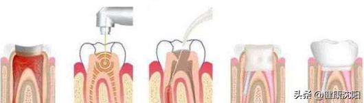 牙掉渣了怎么补救,健康科普堂正确食疗