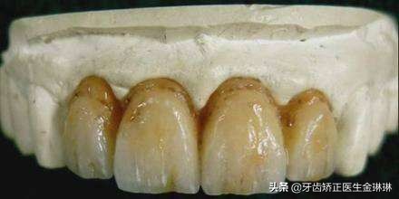 为什么河北人容易有氟斑牙,中国哪些地区会有氟斑牙