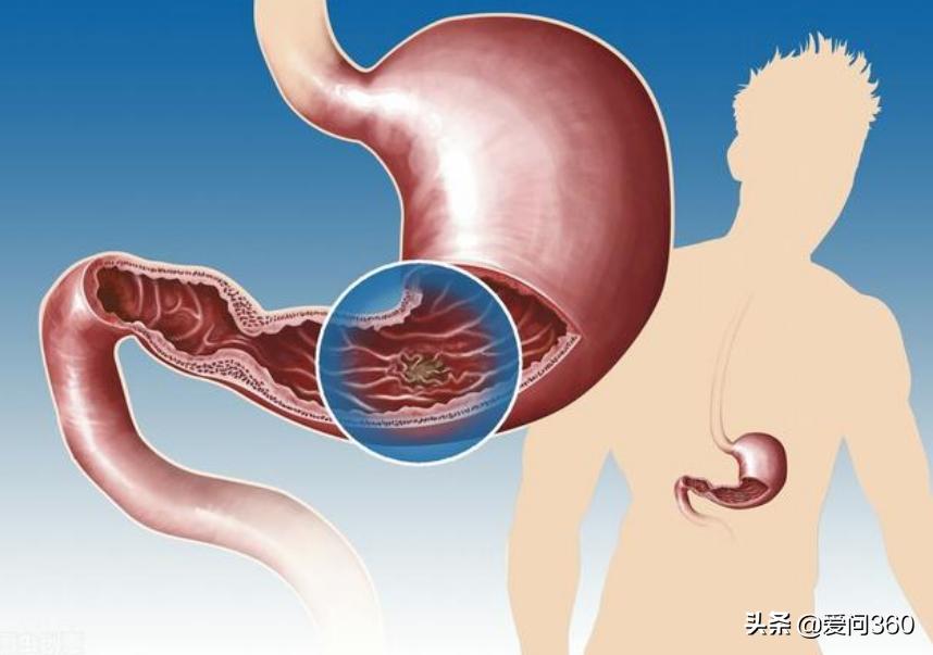 保护胃黏膜修复胃粘膜 (胃黏膜受损如何修复胃黏膜)