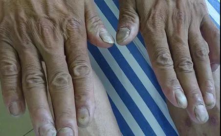 干货来啦!特殊部位的银屑病究竟应该如何护理?