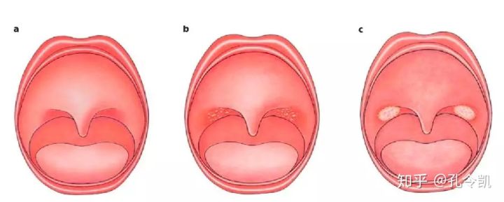 喂奶姿势不当导致孩子兜齿怎么办,宝宝喂奶姿势不对导致的口腔问题