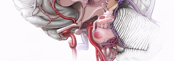 脑干海绵状血管瘤开颅手术,脑干做手术的示意图