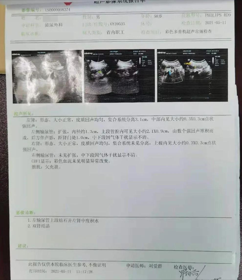 体外碎石做了三次肾结石又复发了,碎石三次了还没排出怎么回事