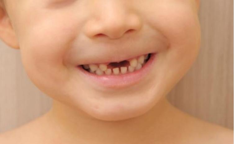 儿童大牙龋齿严重该怎么办,儿童牙有龋齿应该怎么治疗