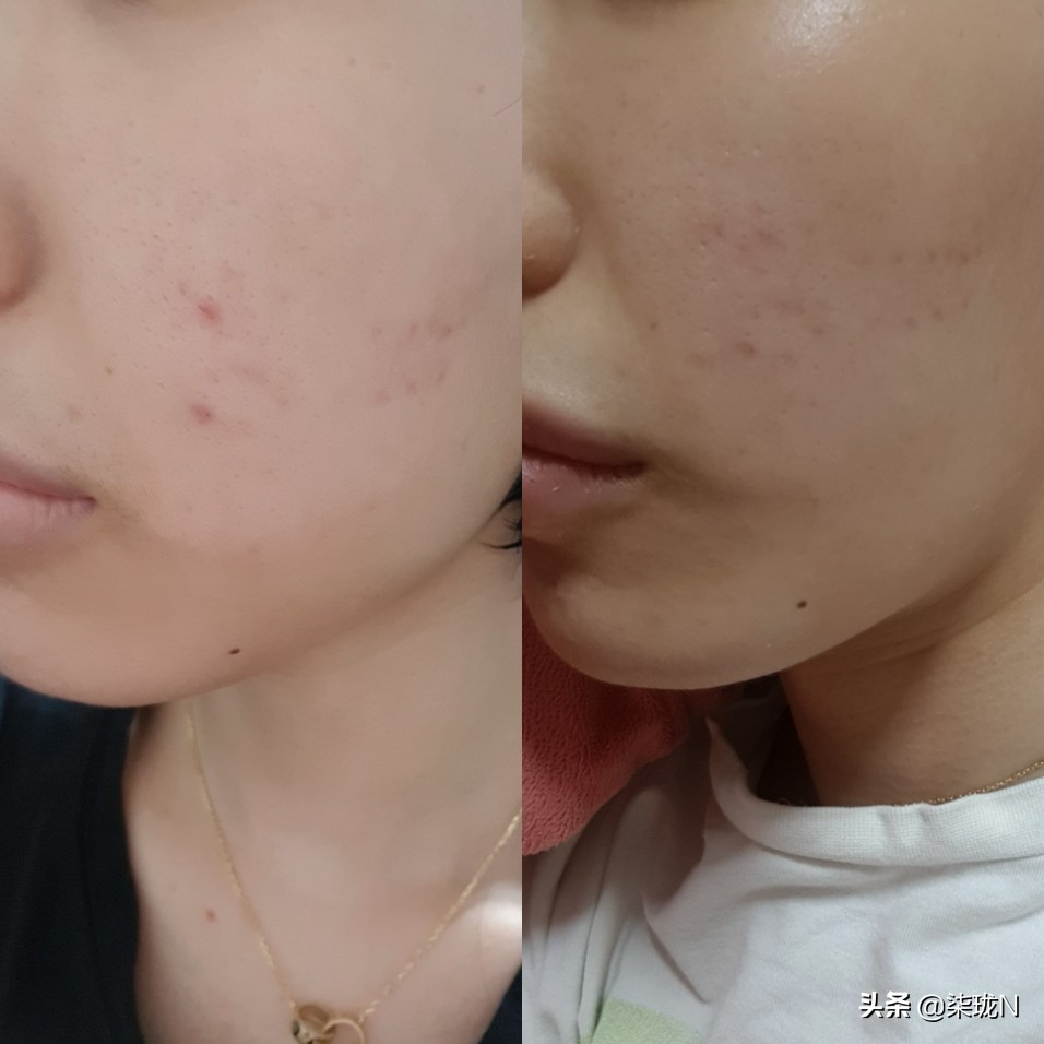 韩国小姐姐对伊安秀Iancell-L产品使用后期真实回馈