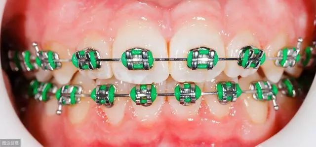 成年人做牙齿矫正合适吗,成年人有必要做牙齿矫正吗
