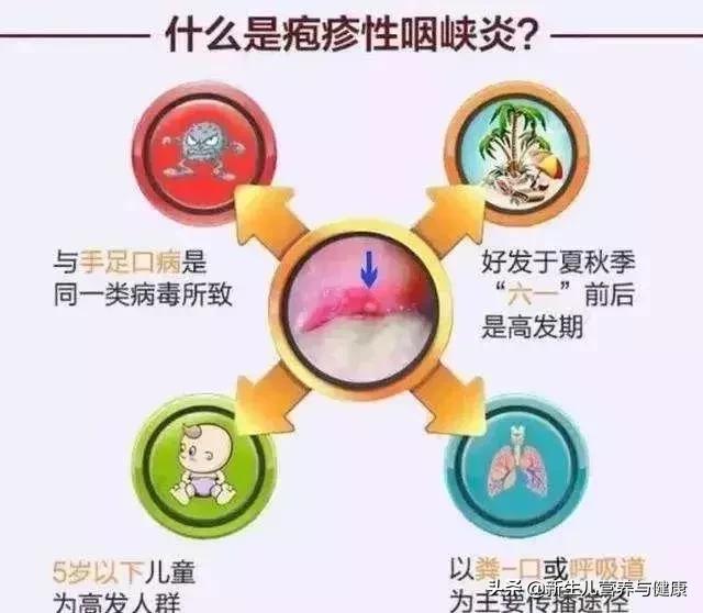 疱疹性咽峡炎可以不用吃药吗,疱疹性咽峡炎用什么药可以预防