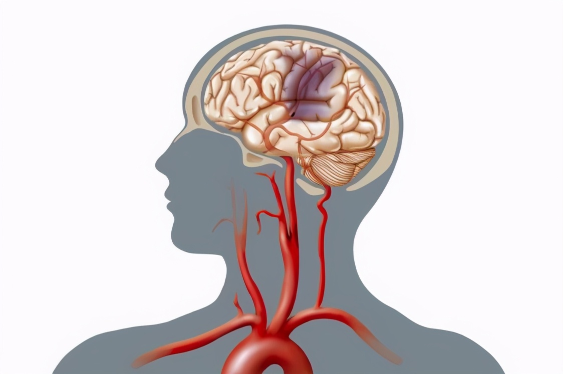 颅内动脉闭塞患者的治疗之路
