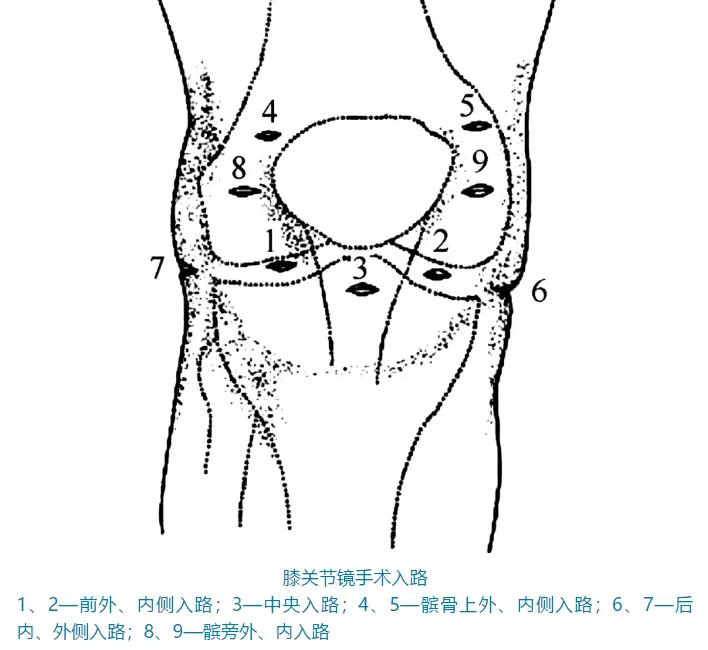 关节镜的适应症是什么,关节镜操作流程及注意事项