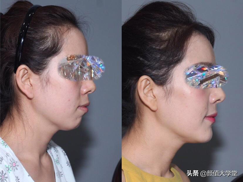 下巴后缩怎么拍侧颜,下巴后缩需要怎么矫正