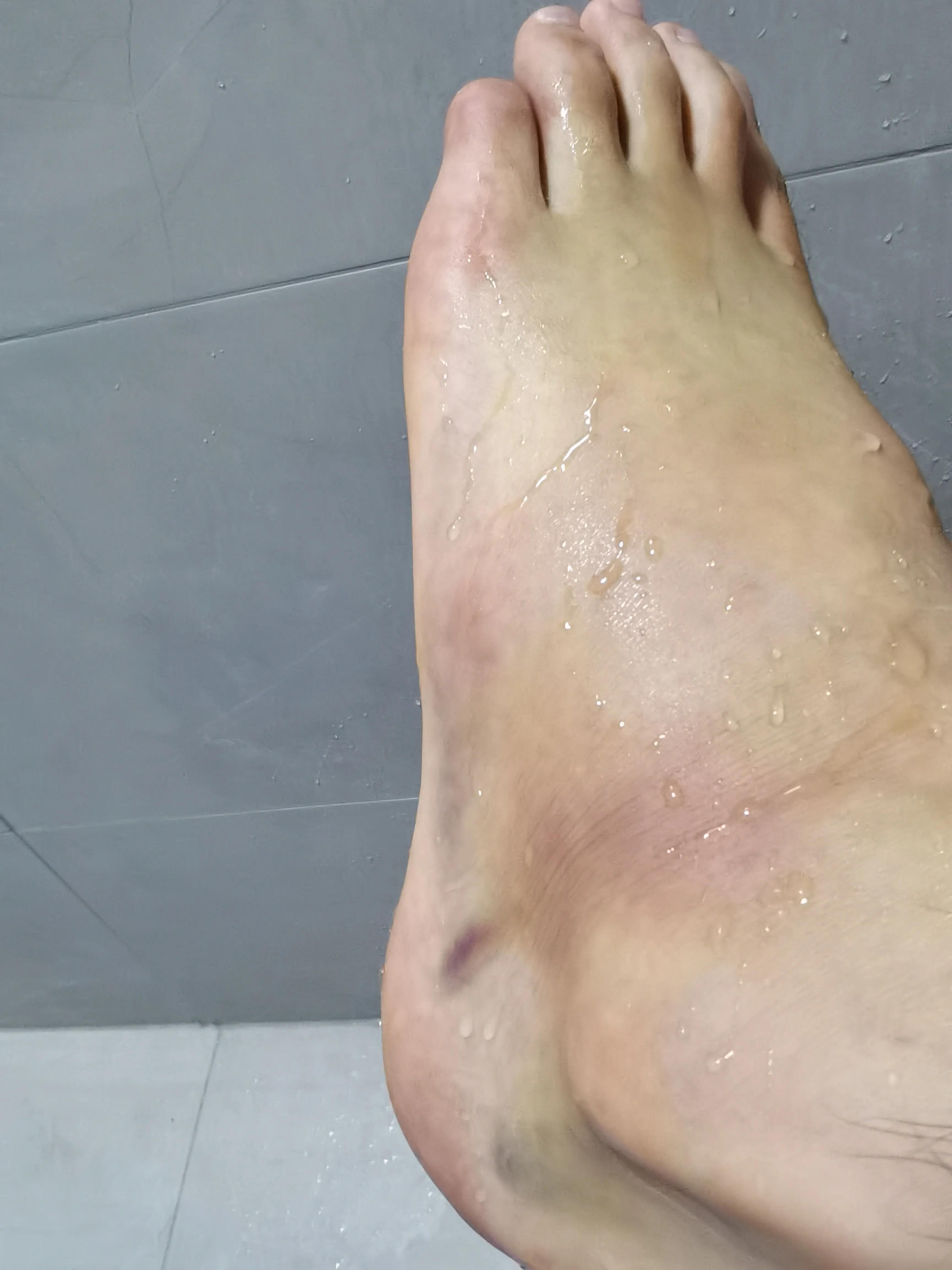 第五跖骨粉碎性骨折多久后能走路,第五跖骨基底骨折100天了走路肿