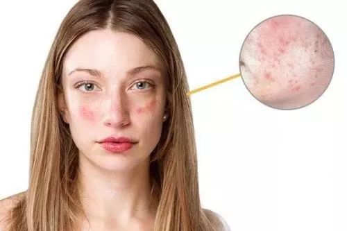 长痘而且很痒怎么办,长痘反复痒是怎么回事