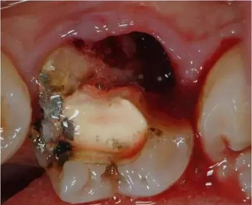 牙齿根管治疗全过程牙髓有个洞,牙髓一旦暴露就必须做根管治疗吗