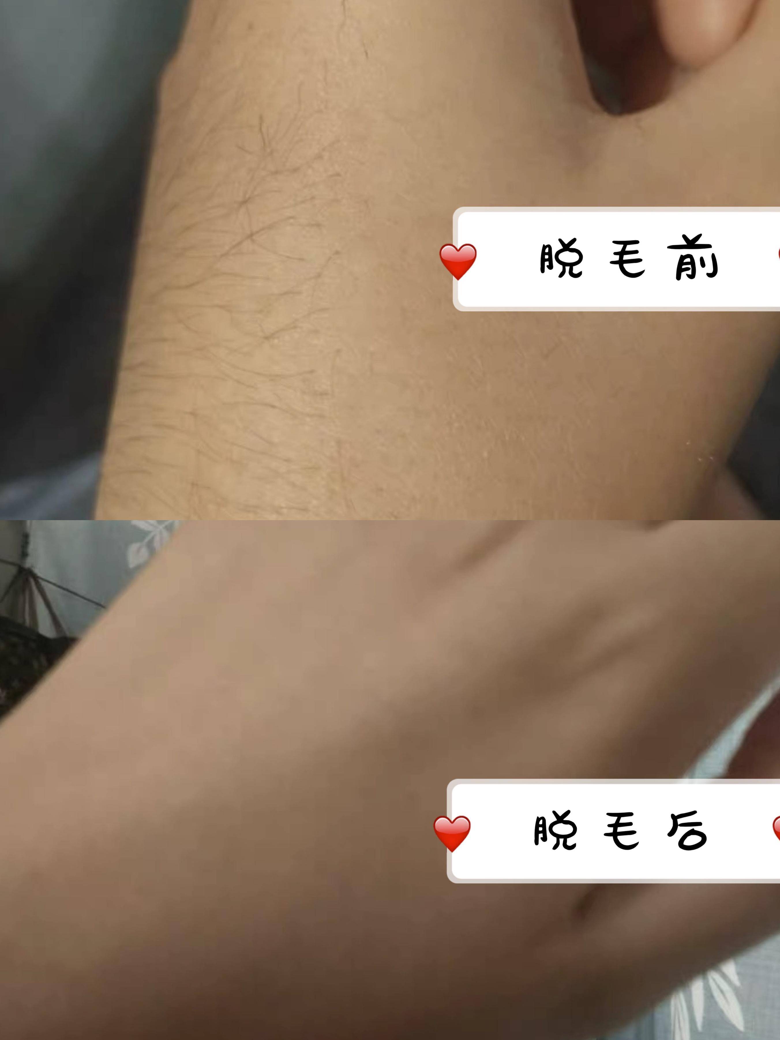 我敢说：这是1000以内zui好用的脱毛仪